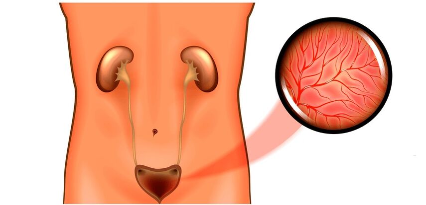 Cystitis in men's symptoms and treatment