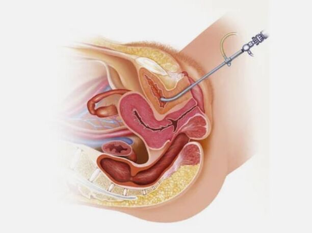 Diagnosis of cystitis